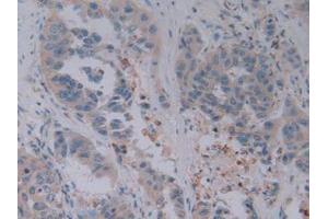IHC-P analysis of Human Breast cancer Tissue, with DAB staining. (GZMB 抗体  (AA 21-247))