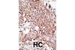 Formalin-fixed and paraffin-embedded human hepatocellular carcinoma tissue reacted with LYVE1 polyclonal antibody  , which was peroxidase-conjugated to the secondary antibody, followed by DAB staining. (LYVE1 抗体  (C-Term))