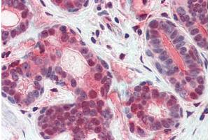 Human Breast (formalin-fixed, paraffin-embedded) stained with ATF6 antibody ABIN351433 at 5 ug/ml followed by biotinylated goat anti-rabbit IgG secondary antibody ABIN481713, alkaline phosphatase-streptavidin and chromogen. (ATF6 抗体  (N-Term))