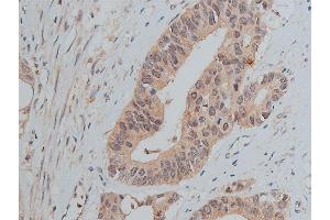 ABIN6256758 and ABIN6267373 at 1/50 staining human colon carcinoma tissue sections by IHC-P. (Src 抗体  (pTyr530))
