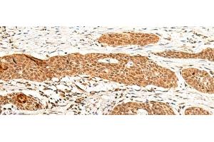 Immunohistochemistry of paraffin-embedded Human esophagus cancer tissue using GTF3A Polyclonal Antibody at dilution of 1:60(x200) (GTF3A 抗体)