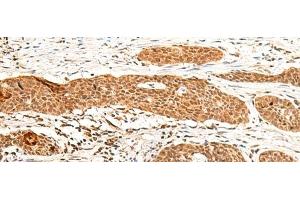 Immunohistochemistry of paraffin-embedded Human esophagus cancer tissue using GTF3A Polyclonal Antibody at dilution of 1:60(x200) (GTF3A 抗体)