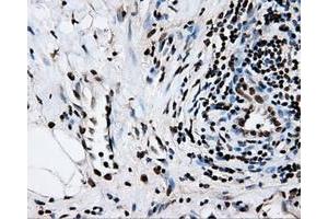 Immunohistochemical staining of paraffin-embedded Adenocarcinoma of colon tissue using anti-RPA2mouse monoclonal antibody. (RPA2 抗体)