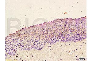 Formalin-fixed and paraffin embedded: human nasopharyngeal carcinoma labeled with Anti-Trk-B Polyclonal Antibody (ABIN725870), Unconjugated at 1:200 followed by conjugation to the secondary antibody and DAB staining (TRKB 抗体  (AA 401-500))