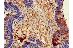 Immunohistochemistry of paraffin-embedded human ovarian cancer using ABIN7149934 at dilution of 1:100 (DPYSL4 抗体  (AA 280-560))