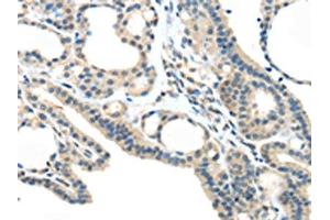 The image on the left is immunohistochemistry of paraffin-embedded Human thyroid cancer tissue using ABIN7193032(VSIG10 Antibody) at dilution 1/45, on the right is treated with synthetic peptide. (VSIG1 抗体)