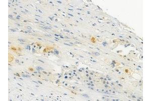 ABIN6257574 and ABIN6274141 at 1/100 staining human lung squamous cell carcinoma by IHC-P.