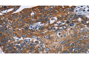 Immunohistochemistry of paraffin-embedded Human cervical cancer tissue using FCGR3A Polyclonal Antibody at dilution 1:40 (FCGR3A 抗体)