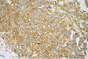 Immunohistochemistry was performed on paraffin-embedded human breast carcinoma using GAPDH antibody (ABIN7798768), 1:500).