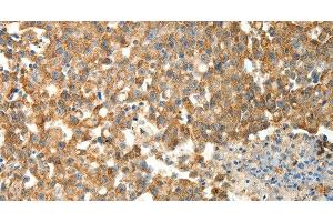 Immunohistochemistry of paraffin-embedded Human breast cancer using PRDX3 Polyclonal Antibody at dilution of 1:50 (Peroxiredoxin 3 抗体)