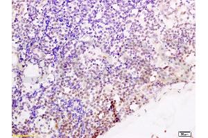 Formalin-fixed and paraffin embedded human endometrium carcinoma tissue labeled with Anti-Cyclin G Polyclonal Antibody, Unconjugated (ABIN685837) at 1:200 followed by conjugation to the secondary antibody and DAB stainin (Cyclin G1 抗体  (AA 181-295))