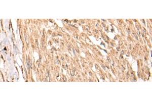 Immunohistochemistry of paraffin-embedded Human cervical cancer tissue using HSF4 Polyclonal Antibody at dilution of 1:55(x200) (HSF4 抗体)