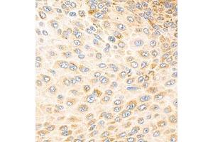 Immunohistochemistry analysis of paraffin-embedded human esophageal cancer using Torsin A (ABIN7075942) at dilution of 1: 800 (TOR1A 抗体)