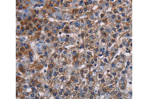 Immunohistochemistry of Human lung cancer using KCNK1 Polyclonal Antibody at dilution of 1:50 (KCNK1 抗体)