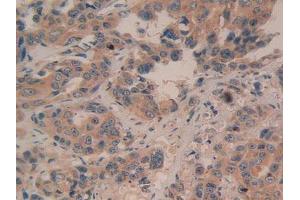 IHC-P analysis of Human Breast Cancer Tissue, with DAB staining. (BAD 抗体  (AA 1-168))