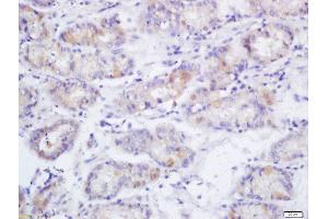 Formalin-fixed and paraffin embedded human gastric cancer labeled with Anti-Phospho-eNOS (Ser1177)Polyclonal Antibody, Unconjugated  at 1:200 followed by conjugation to the secondary antibody and DAB staining (ENOS 抗体  (pSer1177))