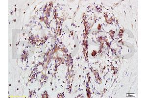Formalin-fixed and paraffin embedded human breast carcinoma tissue labeled with Anti-BRMS-1 Polyclonal Antibody, Unconjugated (ABIN730933) at 1:200 followed by conjugation to the secondary antibody and DAB staining (BRMS1L 抗体  (AA 151-246))