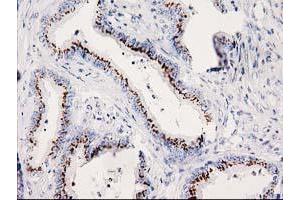 Immunohistochemical staining of paraffin-embedded Adenocarcinoma of Human colon tissue using anti-SOCS3 mouse monoclonal antibody. (SOCS3 抗体)
