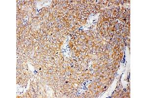 IHC-P: Caspase-12 antibody testing of human lung cancer tissue (Caspase 12 抗体  (AA 71-84))