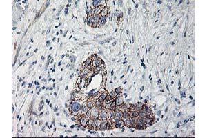 Immunohistochemical staining of paraffin-embedded Adenocarcinoma of Human breast tissue using anti-APBB3 mouse monoclonal antibody. (APBB3 抗体)