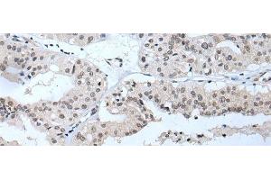 Immunohistochemistry of paraffin-embedded Human liver cancer tissue using TBX1 Polyclonal Antibody at dilution of 1:40(x200) (T-Box 1 抗体)