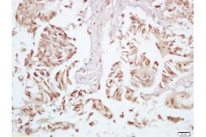 Formalin-fixed and paraffin embedded human colon carcinoma labeled with Rabbit Anti-P70 S6 Kinase beta 2 (Ser370) Polyclonal Antibody, Unconjugated 1:200 followed by conjugation to the secondary antibody and DAB staining (RPS6KB2 抗体  (pSer370))