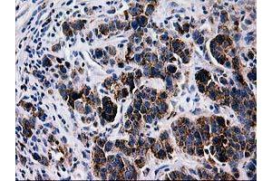 Immunohistochemical staining of paraffin-embedded Carcinoma of Human lung tissue using anti-LGALS3BP mouse monoclonal antibody. (LGALS3BP 抗体)