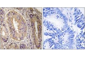 Immunohistochemistry analysis of paraffin-embedded human colon carcinoma tissue, using FAK (Ab-843) Antibody. (FAK 抗体  (AA 809-858))