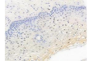ABIN6255654 and ABIN6267462 at 1/100 staining human cervical carcinoma by IHC-P. (Cyclin D3 抗体  (pThr283))