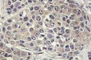 Immunohistochemistry (IHC) analyzes of p-p70 S6 kinase alpha antibody in paraffin-embedded human breast carcinoma tissue. (RPS6KB1 抗体  (pSer447))