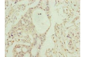Immunohistochemistry of paraffin-embedded human pancreatic cancer using ABIN7148371 at dilution of 1:100 (C8B 抗体  (AA 55-350))