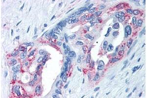 Anti-TRPM8 antibody  ABIN1049436 IHC staining of human prostate carcinoma. (TRPM8 抗体  (Internal Region))