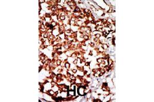 Formalin-fixed and paraffin-embedded human hepatocellular carcinoma tissue reacted with NRBP1 polyclonal antibody  , which was peroxidase-conjugated to the secondary antibody, followed by DAB staining. (NRBP1 抗体  (N-Term))