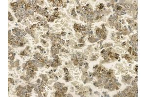 ABIN6255351 and ABIN6267196 at 1/100 staining human renal cell carcinoma by IHC-P. (TPT1 抗体  (pSer46))
