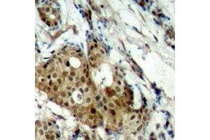 Immunohistochemical analysis of CDK11B staining in human breast cancer formalin fixed paraffin embedded tissue section. (CDK11 抗体  (N-Term))