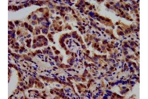 IHC image of ABIN7171895 diluted at 1:700 and staining in paraffin-embedded human lung cancer performed on a Leica BondTM system. (Tetraspanin 9 抗体  (AA 107-203))