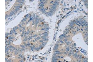 The image on the left is immunohistochemistry of paraffin-embedded Human colon cancer tissue using ABIN7130139(MAGEB4 Antibody) at dilution 1/40, on the right is treated with fusion protein. (MAGEB4 抗体)