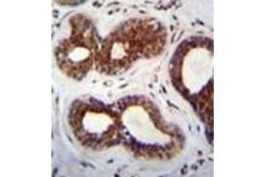 Immunohistochemistry analysis in formalin fixed and paraffin embedded human breast tissue recated with KIAA1586 Antibody (N-term) followed by peroxidase conjugation of the secondary antibody and DAB staining. (KIAA1586 抗体  (N-Term))
