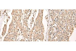 Immunohistochemistry of paraffin-embedded Human prost ate cancer tissue using ATAD3A Polyclonal Antibody at dilution of 1:40(x200) (ATAD3A 抗体)