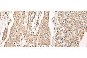 Immunohistochemistry of paraffin-embedded Human prost ate cancer tissue using ATAD3A Polyclonal Antibody at dilution of 1:40(x200)