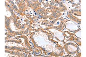 The image on the left is immunohistochemistry of paraffin-embedded Human thyroid cancer tissue using ABIN7128162(ACOT11 Antibody) at dilution 1/25, on the right is treated with fusion protein. (ACOT11 抗体)