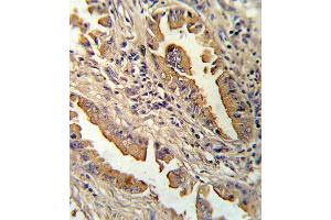 Formalin-fixed and paraffin-embedded human lung carcinoma reacted with IL8 Antibody (C-term), which was peroxidase-conjugated to the secondary antibody, followed by DAB staining. (IL-8 抗体  (C-Term))
