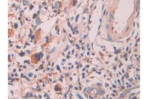 Detection of SAP in Human Stomach cancer Tissue using Polyclonal Antibody to Serum Amyloid P Component (SAP)