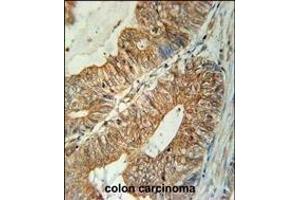 TSN3 Antibody (Center) (ABIN651749 and ABIN2840386) immunohistochemistry analysis in formalin fixed and raffin embedded human colon carcinoma followed by peroxidase conjugation of the secondary antibody and DAB staining. (Tetraspanin 3 抗体  (AA 90-117))