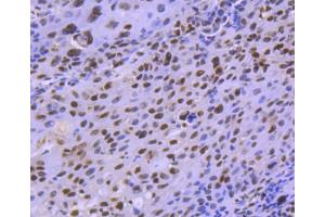 Paraformaldehyde-fixed, paraffin embedded human lung carcinoma, Antigen retrieval by boiling in sodium citrate buffer (pH6) for 15min, Block endogenous peroxidase by 3% hydrogen peroxide for 30 minutes, Blocking buffer (normal serum) at 37°C for 20min, Antibody incubation with HDAC8 (4C3) Monoclonal Antibody  at 1:50 overnight at 4°C, followed by a conjugated secondary and DAB staining. (HDAC8 抗体)