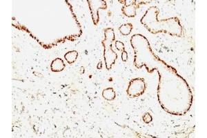 Formalin-fixed, paraffin-embedded human breast carcinoma stained with Calponin antibody (CNN1/832 + CALP). (Calponin 抗体)