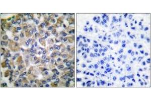 Immunohistochemistry analysis of paraffin-embedded human breast carcinoma tissue, using GRP75 Antibody. (HSPA9 抗体  (AA 630-679))