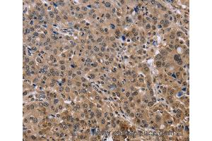 Immunohistochemistry of Human thyroid cancer using KIF25 Polyclonal Antibody at dilution of 1:40