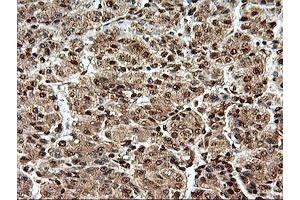 Immunohistochemical staining of paraffin-embedded Carcinoma of Human liver tissue using anti-SAMHD1 mouse monoclonal antibody. (SAMHD1 抗体)