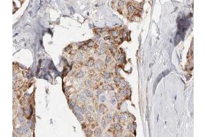 ABIN6266941 at 1/100 staining human Breast cancer tissue sections by IHC-P. (PHLDA2 抗体  (Internal Region))